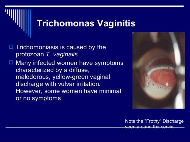 trichomoniasis vaginal photo Trichomoniasis vaginal photo